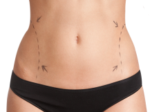 liposuccion et abdominoplastie en Tunisie