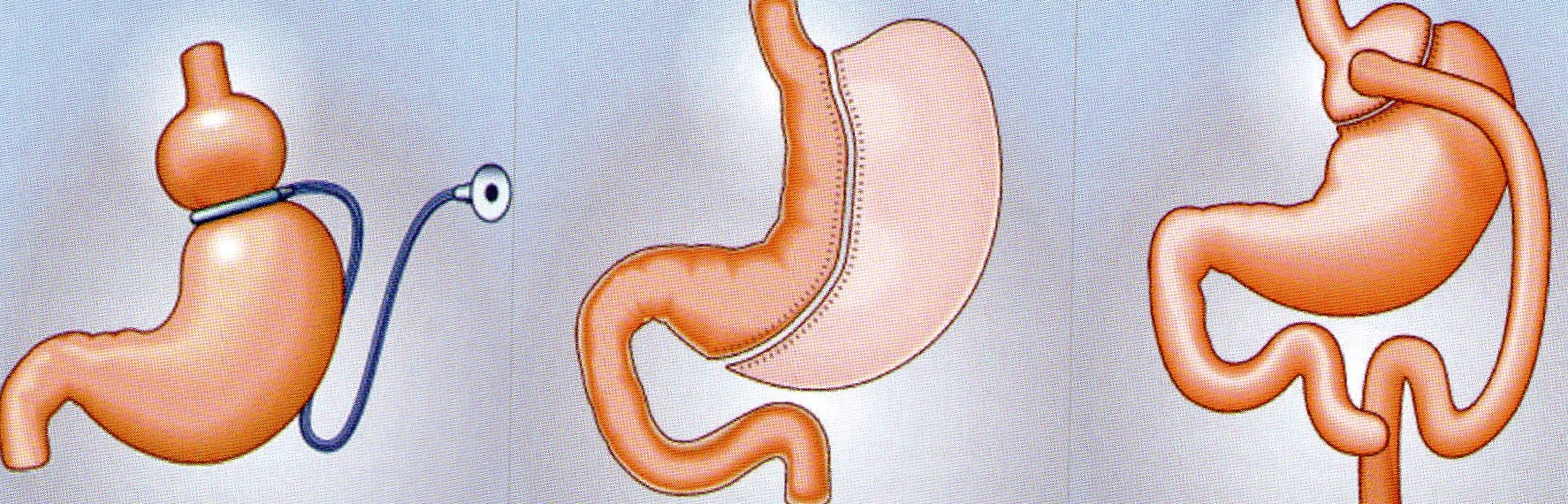 Желудок после бариатрической операции. Бариатрия резекция желудка. Гастропластика (резекция желудка). Бариатрическая операция на желудке. Операции на желудке при ожирении.