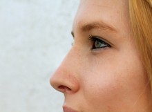 Rhinoplastie resultat