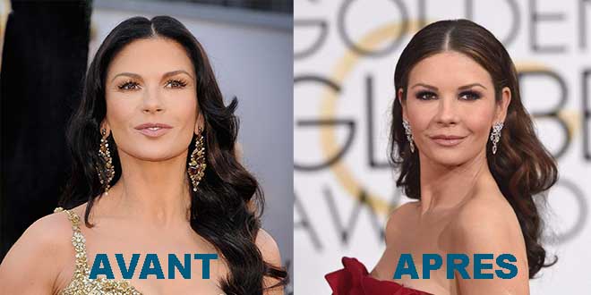 catherine-Zeta-Jones-avant-aprÃ¨s-chirurgie