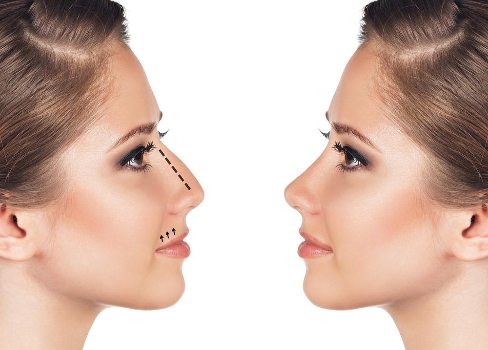 rhinoplastie tunisie