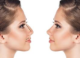 rhinoplastie