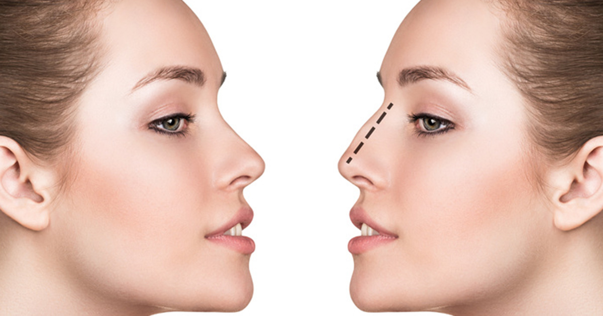 rhinoplastie tunisie