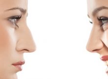 La rhinoplastie