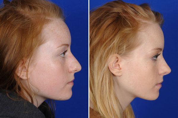 rhinoplastie