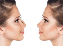 rhinoplastie en tunisie