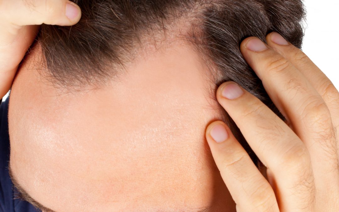 Injection PRP cheveux tunisie