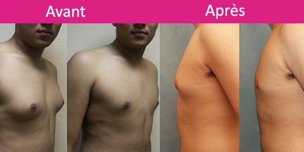 gynecomastie avant aprés