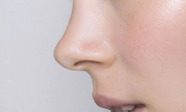 rhinoplastie